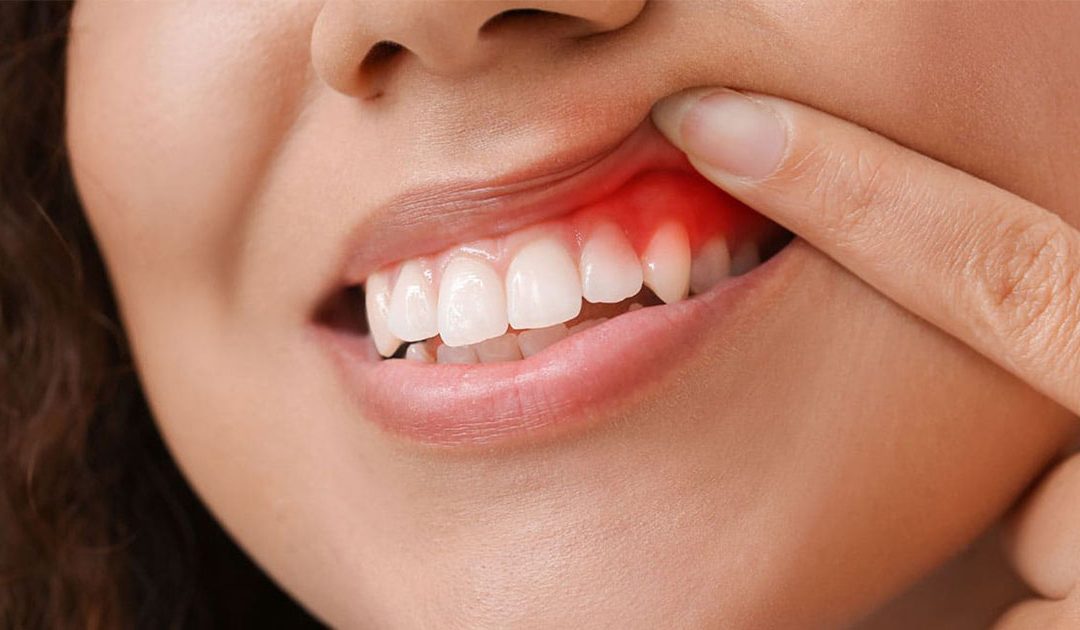 5 Early Signs of Gum Disease